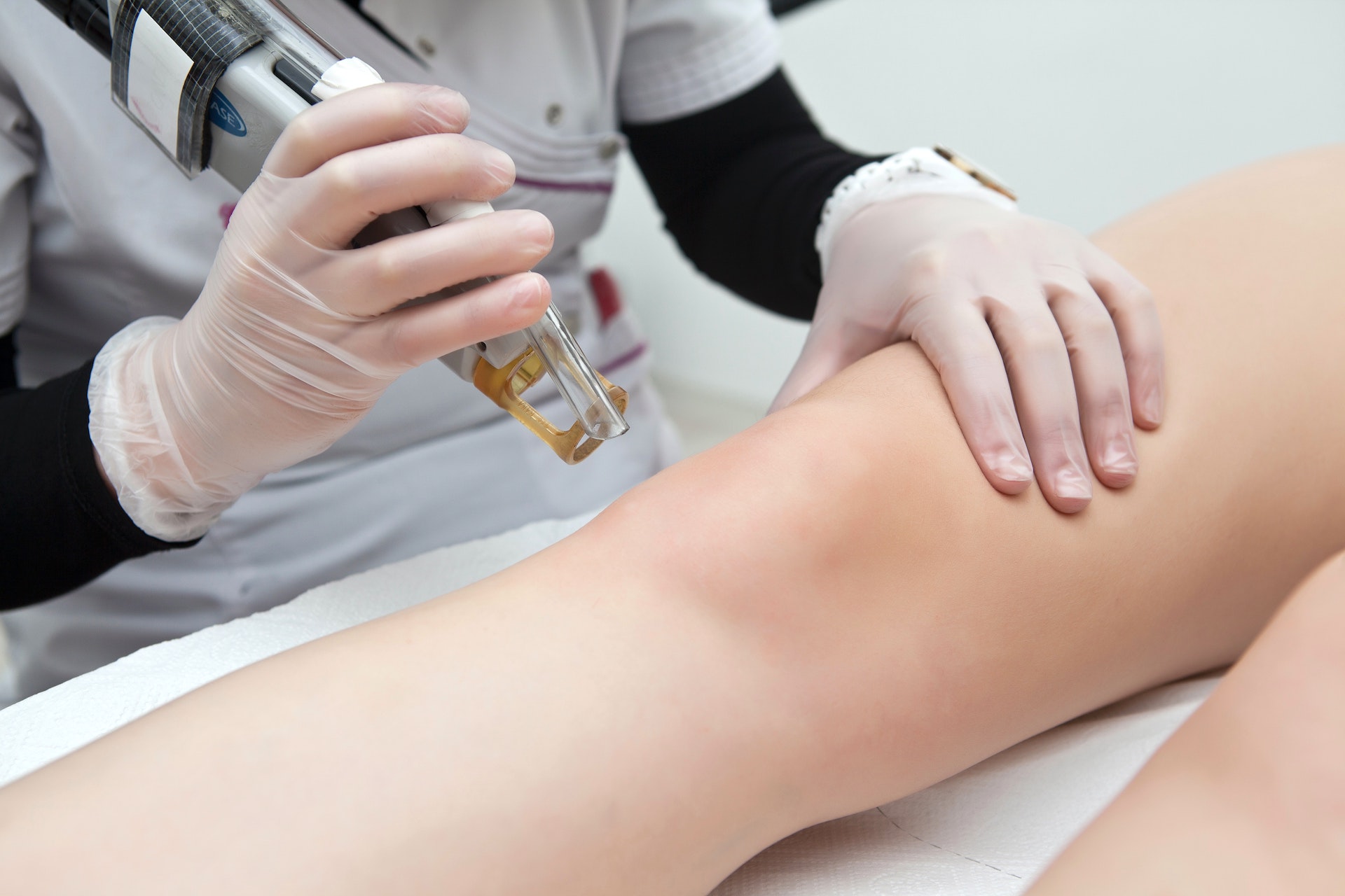 epilazione laser definitiva